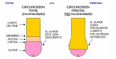 Estilos de circuncisión - Total y parcial