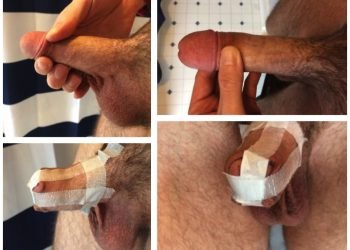 Cinta en cruz: el método de restauración más sencillo