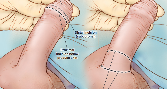 Circuncisión cosmética: una alternativa que no mutila el tejido sensible