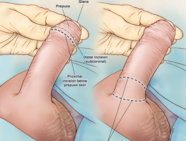 Circuncisión cosmética: una alternativa que no mutila el tejido sensible