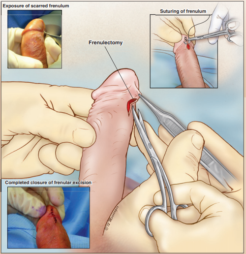 Circuncisión cosmética: 2. Frenulectomía