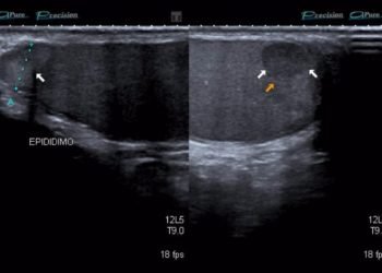 La raya que marcó al tigre: una historia sobre el cáncer testicular