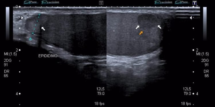 La raya que marcó al tigre: una historia sobre el cáncer testicular